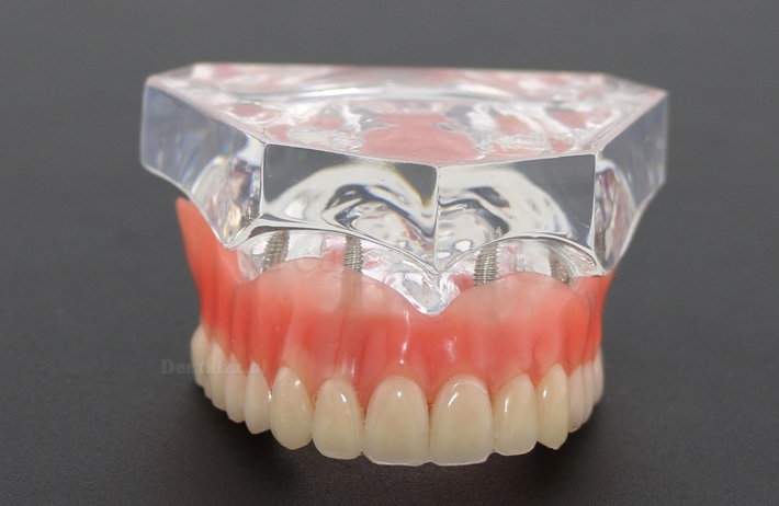 Tandheelkundige studie Tanden Model Overdenture met 4 implantaten Demo Model 6001